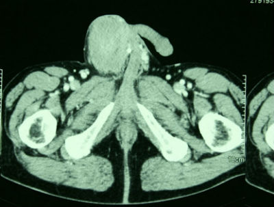 Tumore Testicolo urologo brescia